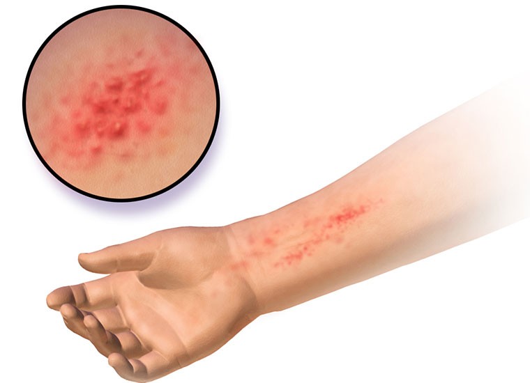 Dermatite atopica, cause e terapia