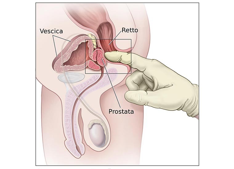 Prostatite, sintomi, cause e rimedi