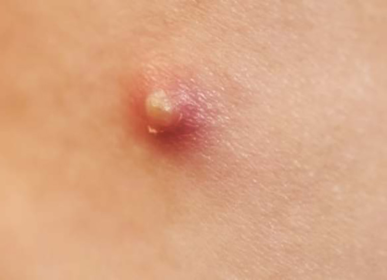 Brufoli Sul Sedere Motivi E Rimedi Per Non Averne Brufoli Sul Sedere Motivi E Rimedi Per Non Averne