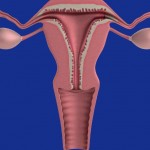 iperplasia endometriale