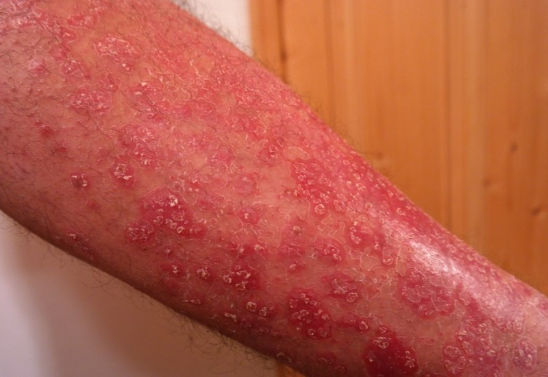 Causa, sintomi e cure della dermatite alle mani