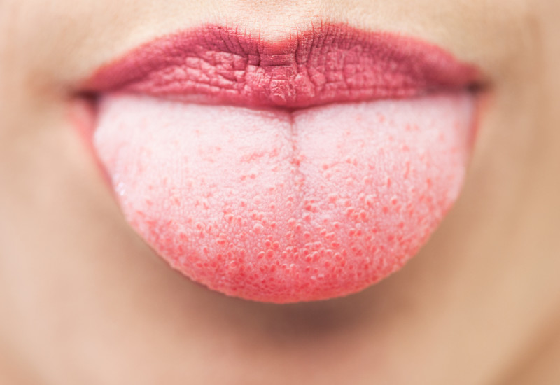 Lingua bianca: un sintomo, tante cause